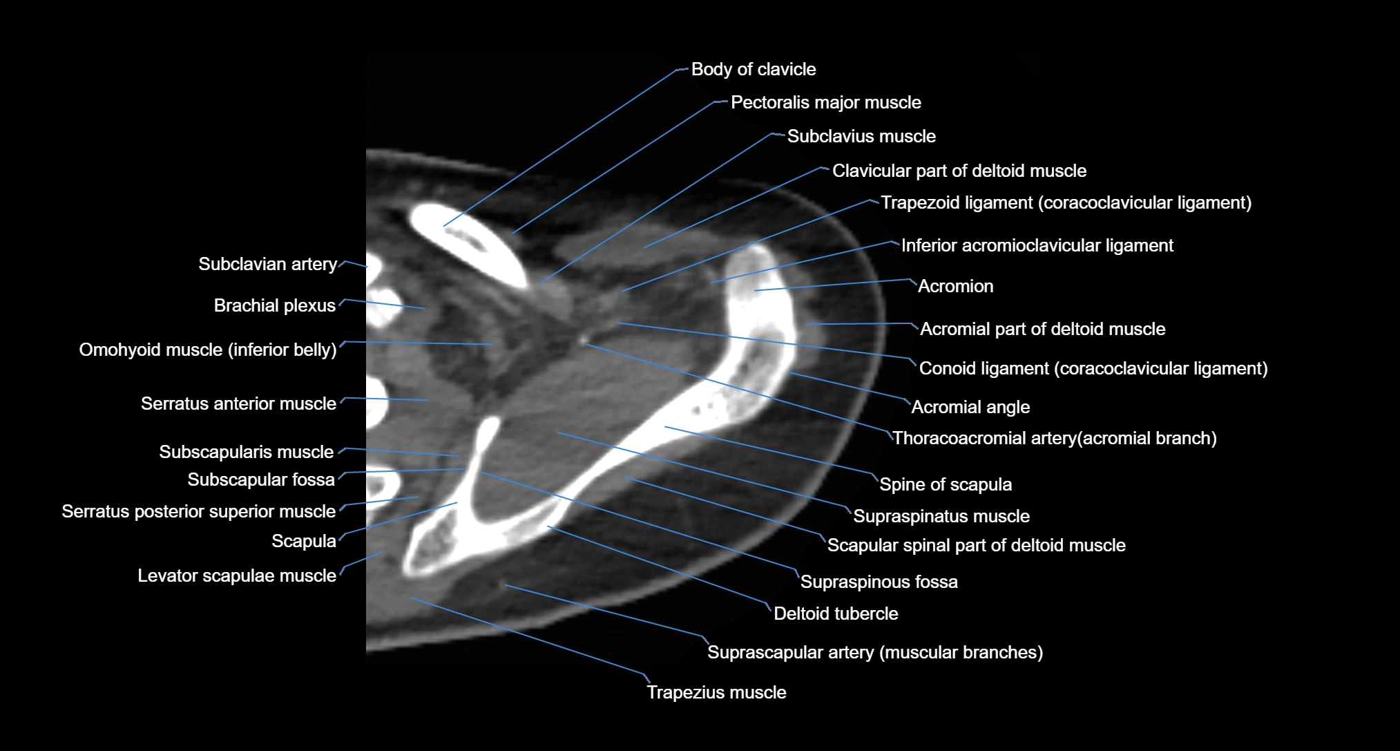CT Shoulder axial cross sectional anatomy labelled radiology image -00018.webp